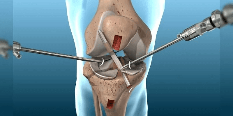 Arthroscopic Surgery
