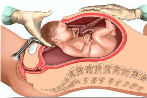 Cesarean & Surgical Procedures
