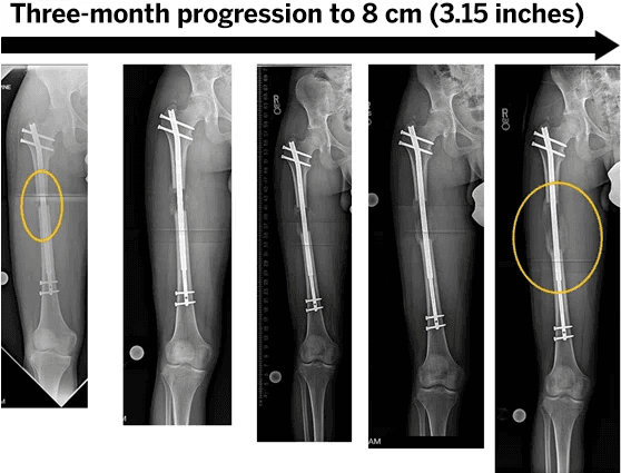Limb Lengthening & Deformity Correction