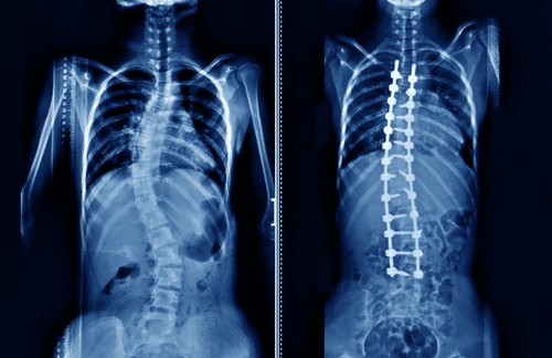 Spine Surgery & Fracture Treatment