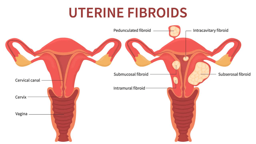 Uterine Fibroid Surgery